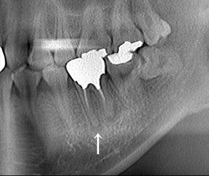 左下第一大臼歯が不十分な根管充填がなされており根尖病変が形成されているレントゲン写真