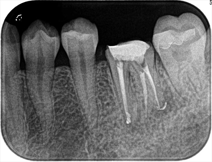 4根管性の左下第一大臼歯をサーマフィルのシステムで垂直加圧根管充填したレントゲン写真