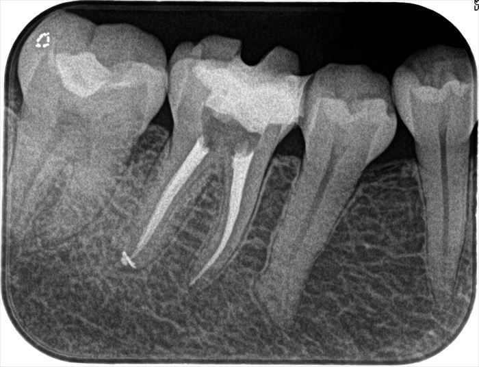 右下奥歯の再根管治療・根管充填を行いました。2023.10.19｜広島