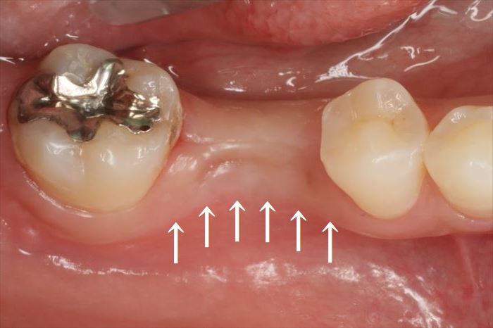 インプラント埋入後の角化歯肉及び歯槽骨の陥凹がわかる写真
