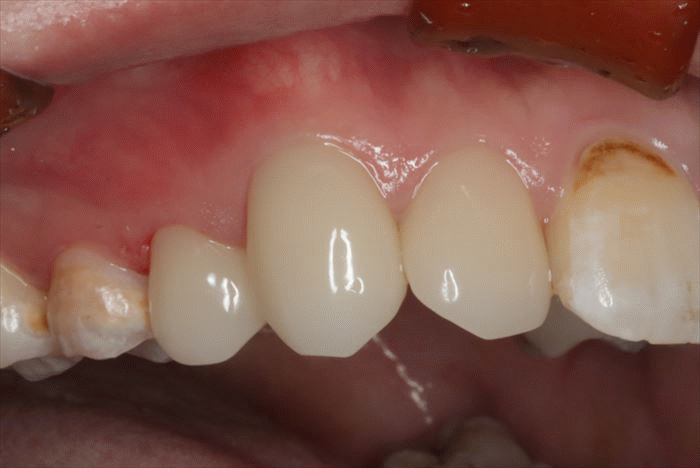 右上前歯の審美歯科セラミック治療ビフォーアフター広島