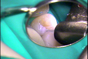 ドリルがエナメル質を通過すると、むし歯による内部の空洞にスポっと入ったGIF動画