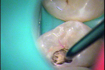 金属製のサジ状の器具であるエキスカベータで軟化象牙質を取っているGIF動画