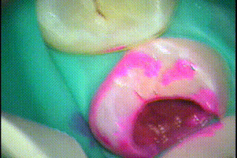 う蝕検知液で軟化象牙質を染色して洗い流すGIF動画