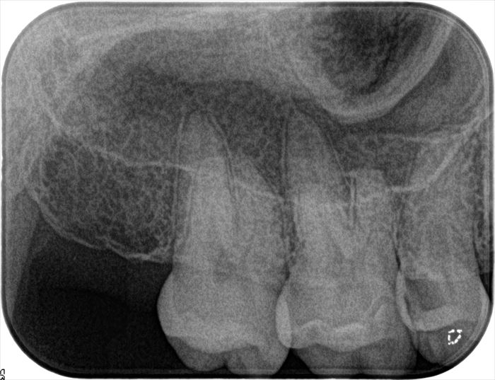 見た目にはわかりにくいむし歯がある左上第二小臼歯のレントゲン写真