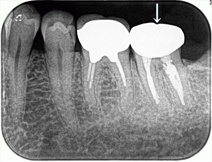 左下奥歯の歯の神経の治療のやりなおし 2023.12.16｜再根管治療