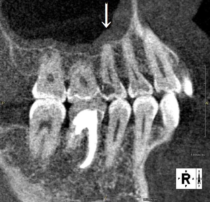 見た目にはわかりにくいむし歯がある左上第二小臼歯の歯科用CT断層画像写真