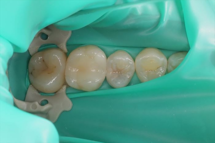 見た目にはわかりにくいむし歯がある左上第二小臼歯の治療のためにラバーダムを装着した写真