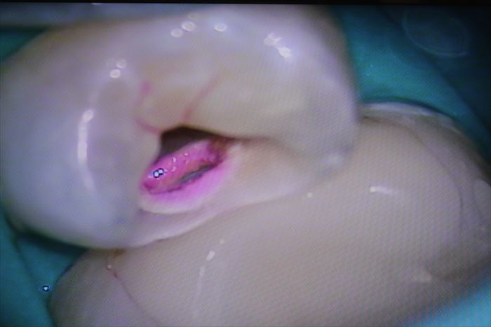 隣接面のむし歯になっていた穴の部分の写真