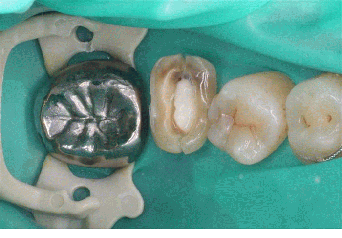 左下第二大臼歯の金属のかぶせものとスクリューポストを除去しました。2024.01.12