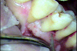周囲の肉芽組織と歯根表面の歯石を超音波スケーラーで取り除くGIF動画