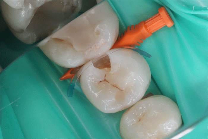 左下第二小臼歯のむし歯をコンポジットレジン修復しました。2024.01.27
