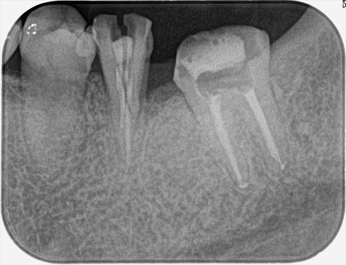 左下第二大臼歯の顕微鏡 再根管治療を終えました。2024.01.31｜マイクロスコープ