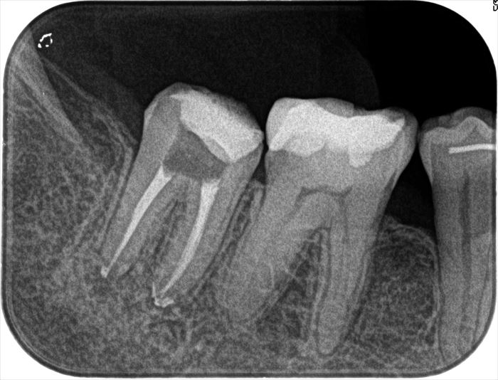 右下第二大臼歯の再根管治療を終えました。2024.02.07｜垂直加圧根管充填