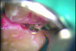 左上第一大臼歯のコンポジットレジン修復を行いました。2024.02.17｜小学6年生