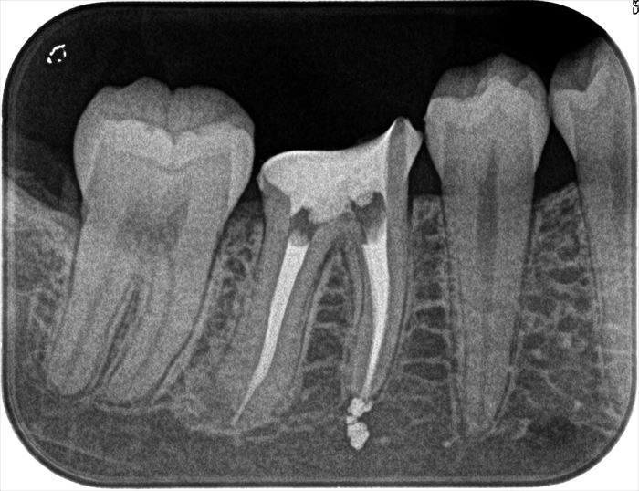 右下第一大臼歯の再根管治療を終えました。2024.03.05｜歯根の先端まで根管充填