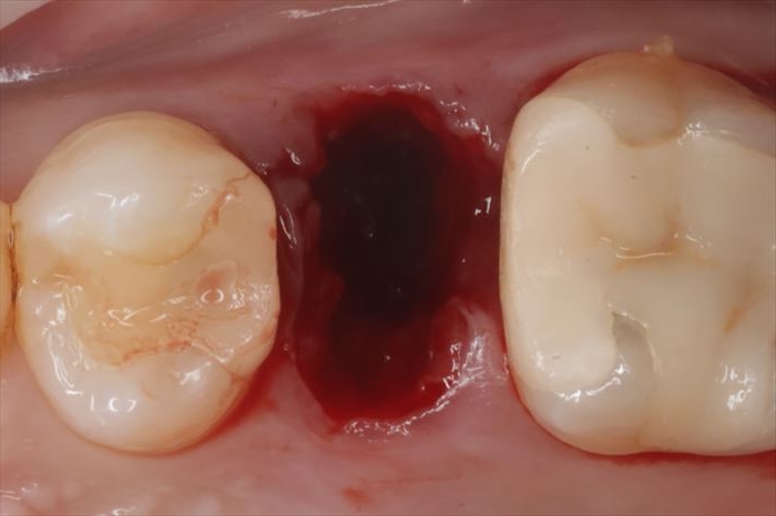 左上第二小臼歯の抜歯後の抜歯窩の写真