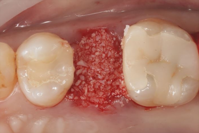 抜歯後に骨移植材を填入した状態の写真。GBR・ソケットプリザーベーション