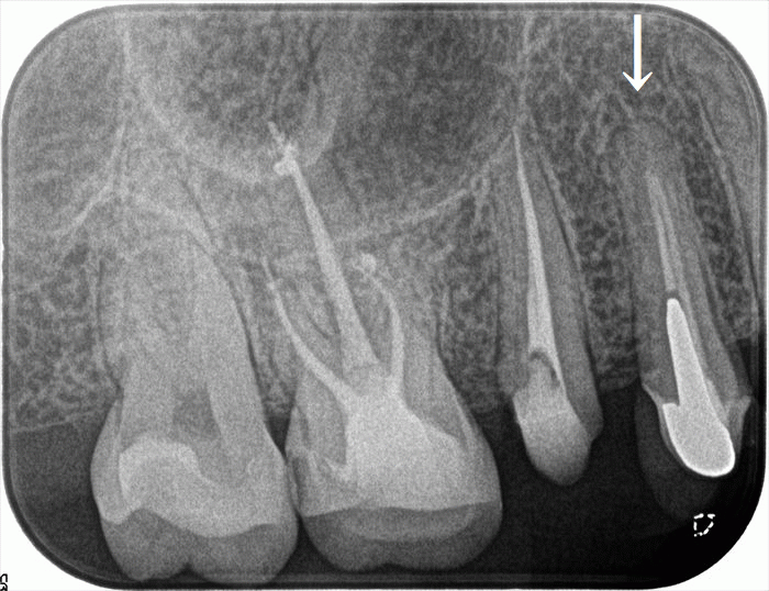 右上第一小臼歯の再根管治療の術前術後ビフォーアフターのレントゲン写真
