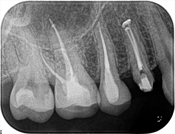 2根管性の右上第一小臼歯の垂直加圧根管充填後のデンタルレントゲン写真