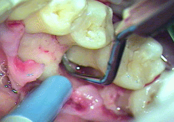 歯周病で骨が溶けた右下奥歯の再生治療 2024.04.05｜重度の歯槽膿漏｜広島