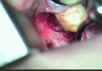左下第二大臼歯の歯周病再生治療 2024.04.11｜歯周ポケットから排膿