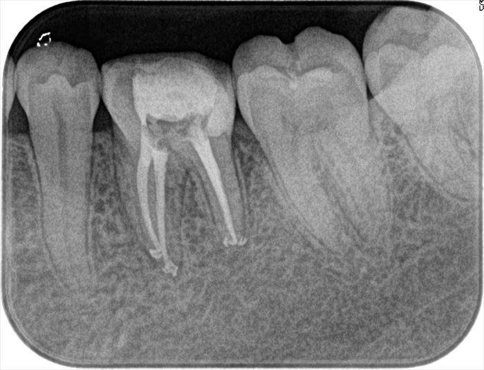 残髄症状のあった左下第一大臼歯の再根管治療を行いました。2024.04.20