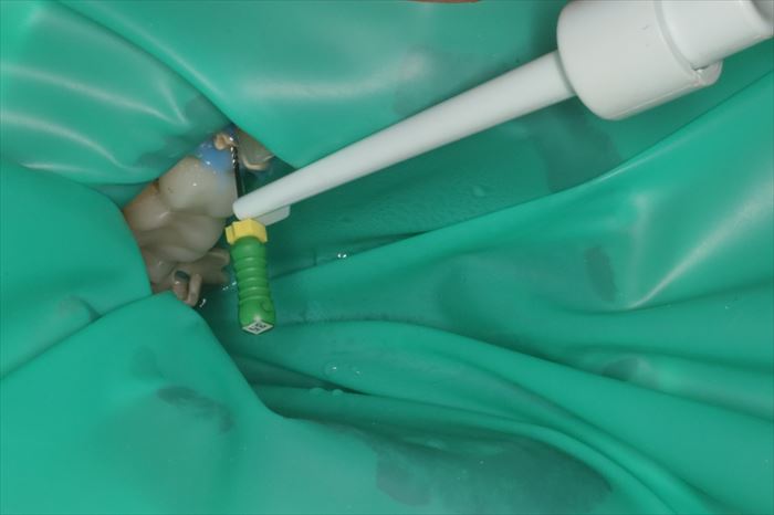 根管治療の際にラバーダムを装着して電気的根管長測定（EMR）を行っている場面の写真