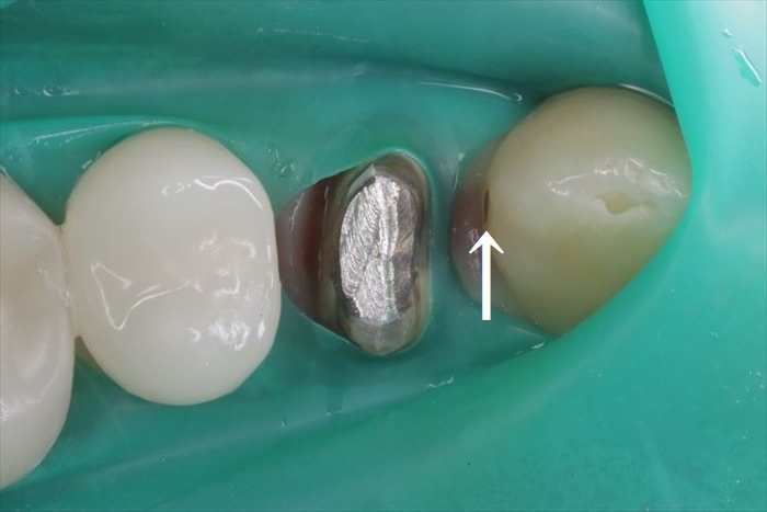 レジンクラウンは細菌付着性が高いため、隣接歯にむし歯を作っていることが判る写真