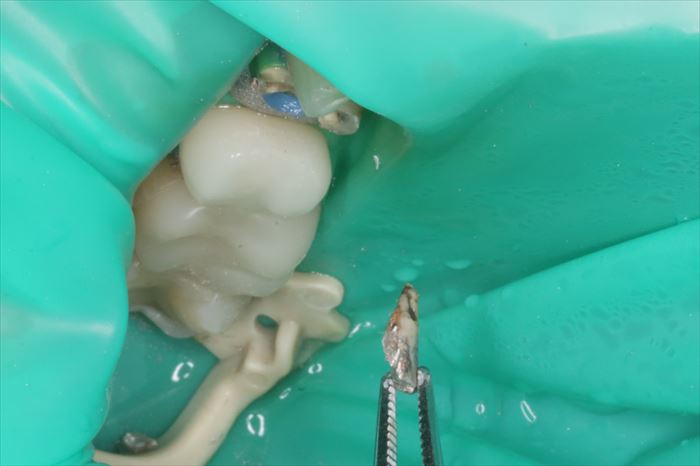 右上第一小臼歯のメタルコアを除去した場面の写真
