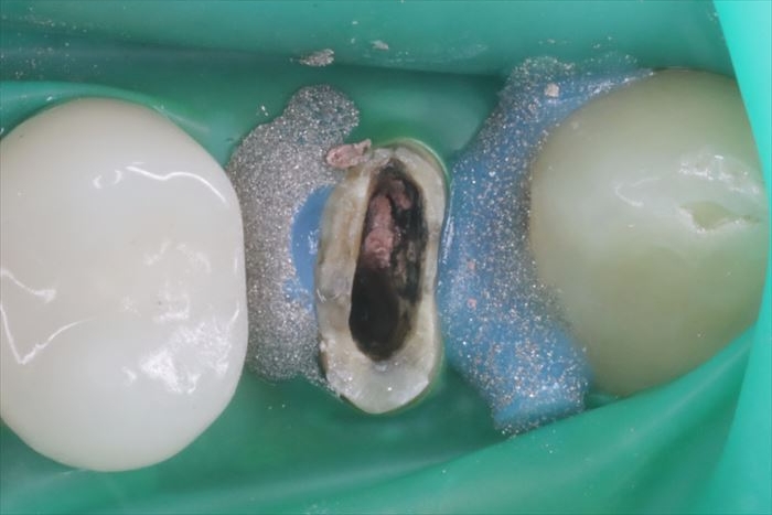 右上第一小臼歯のメタルコアを除去した後の状態。汚染されている写真