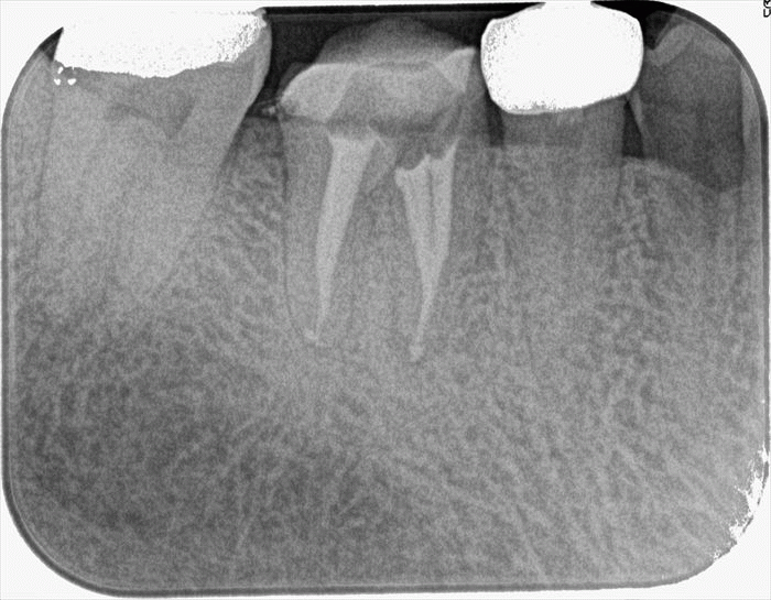 右下奥歯のメタルコアを除去して再根管治療を行いました。2024.04.26｜根の治療やりなおし