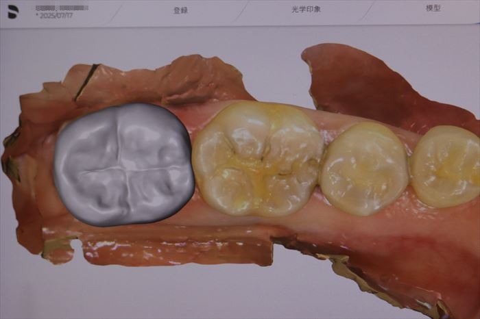 左下第二大臼歯の咬合面をセレックプライムスキャンで構成デザインした画面撮り写真